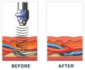 Laser Treatment